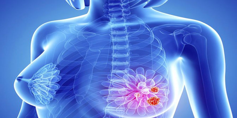 نشانه های سرطان پستان بدخیم