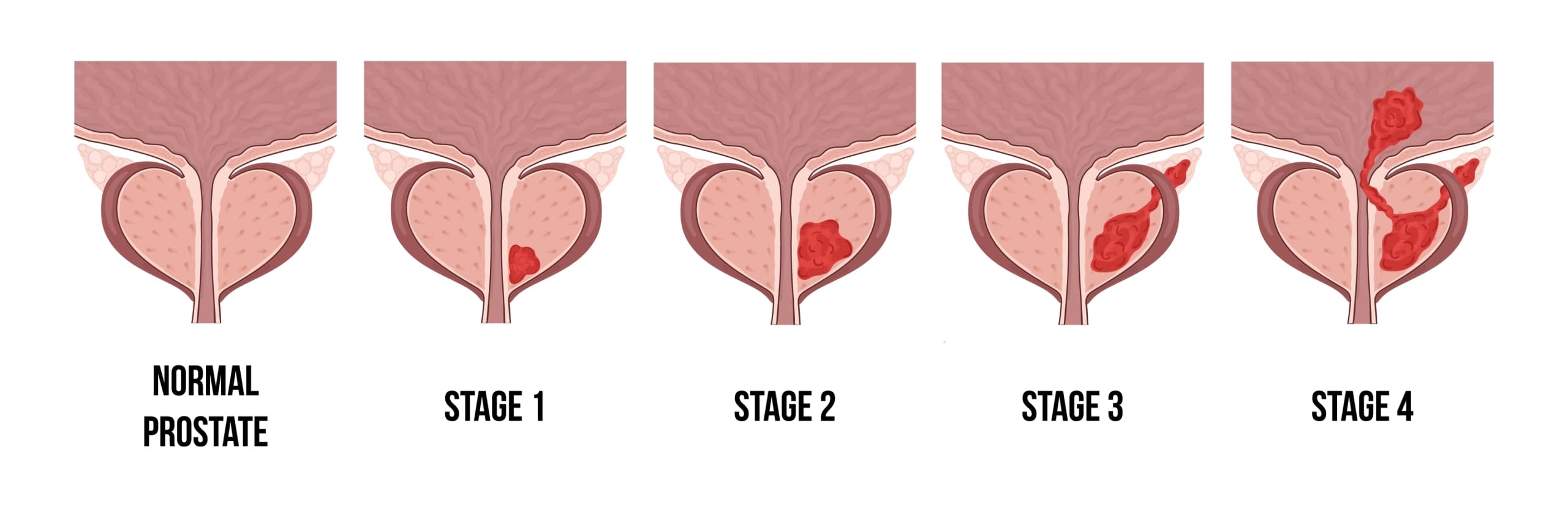 stages-of-prostate-cancer-scaled-1 Stages-Of-Prostate-Cancer-Scaled-1