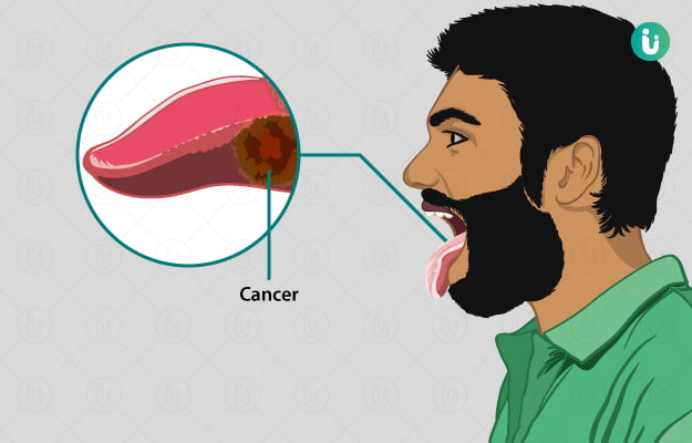 سرطان دهان و زبان و لب بیماری مهمی است که شناخت علائم، عوامل خطرساز، و راههای پیشگیری آن میتواند نقش بسزایی در کاهش شیوع و بهبود پیامدهای آن داشته باشد. تشخیص زودهنگام از طریق معاینات منظم و توجه به علائم هشداردهنده، کلید موفقیت در درمان این بیماری است. درمان سرطان دهان و زبان یک فرآیند چندوجهی است که اغلب شامل ترکیبی از جراحی، رادیوتراپی، شیمیدرمانی، درمان هدفمند، و ایمونوتراپی میشود. رادیوتراپی و ایمونوتراپی به عنوان روشهای درمانی قدرتمند، به خصوص در موارد پیشرفتهتر بیماری، نقش حیاتی ایفا میکنند. انتخاب پزشک متخصص مجرب و باتجربه، مانند دکتر هلاله خوشبخت بهترین متخصص درمان سرطان دهان و زبان، برای تدوین و اجرای یک برنامه درمانی شخصیسازی شده و جامع ضروری است. با اقدامات پیشگیرانه مناسب و مراقبتهای پیگیرانه پس از درمان، میتوان کیفیت زندگی بیماران مبتلا به این سرطان را به طرز چشمگیری بهبود بخشید. سرطان دهان و زبان